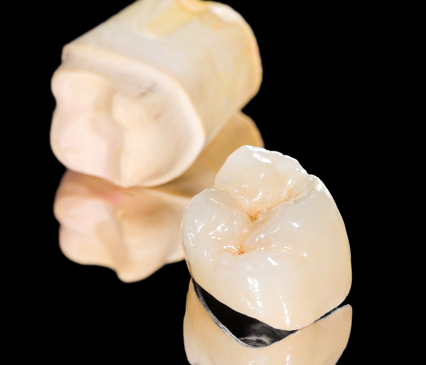 E max ceramic dental crown